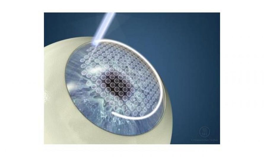 The Role of Femtosecond Lasers in Bladeless LASIK