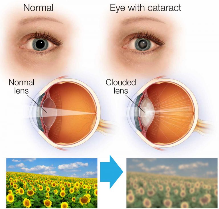Understanding Cataracts surfery Laxmi eye hospital