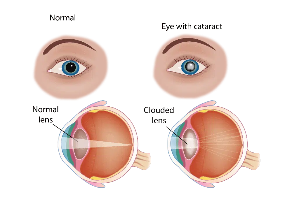 Cataract Surgry