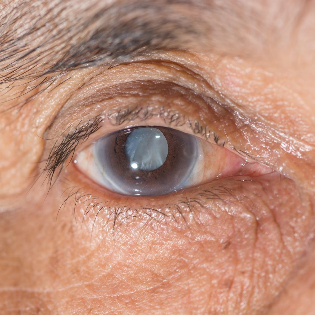 cataract prevention tips by laxmi eye hospital