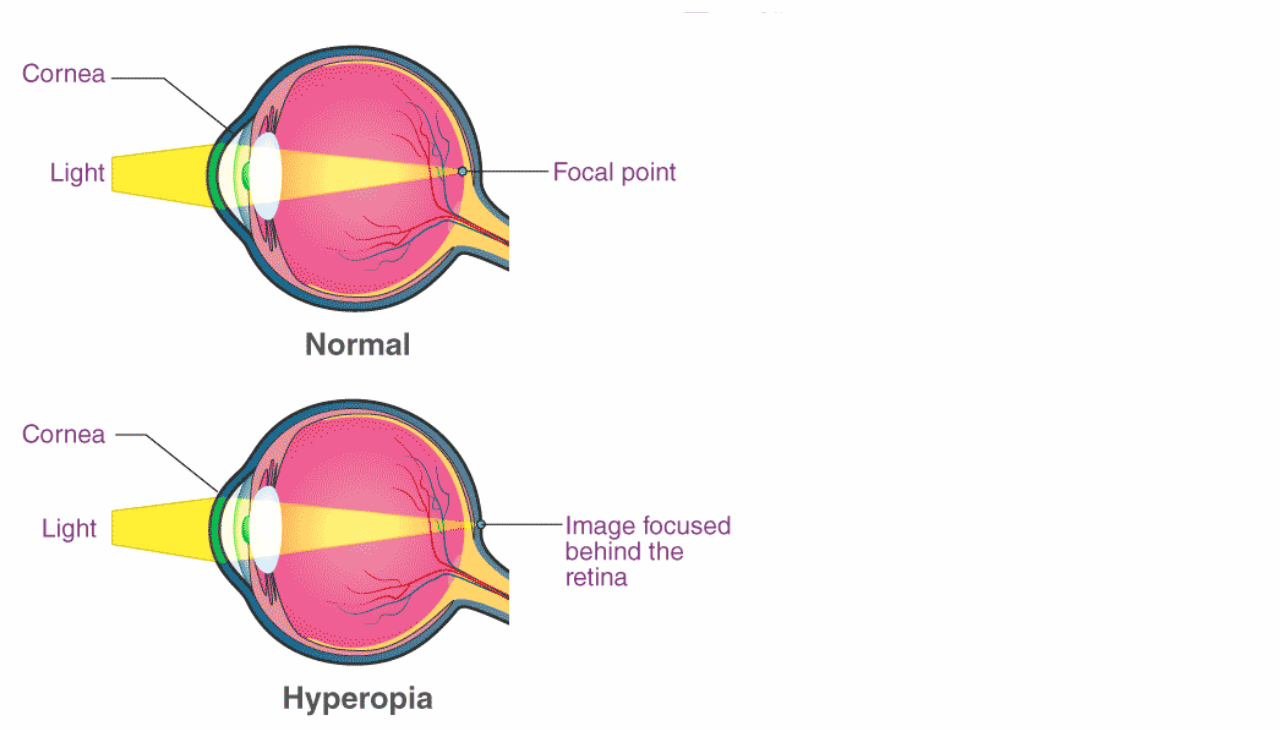 Causes of Hypermetropia