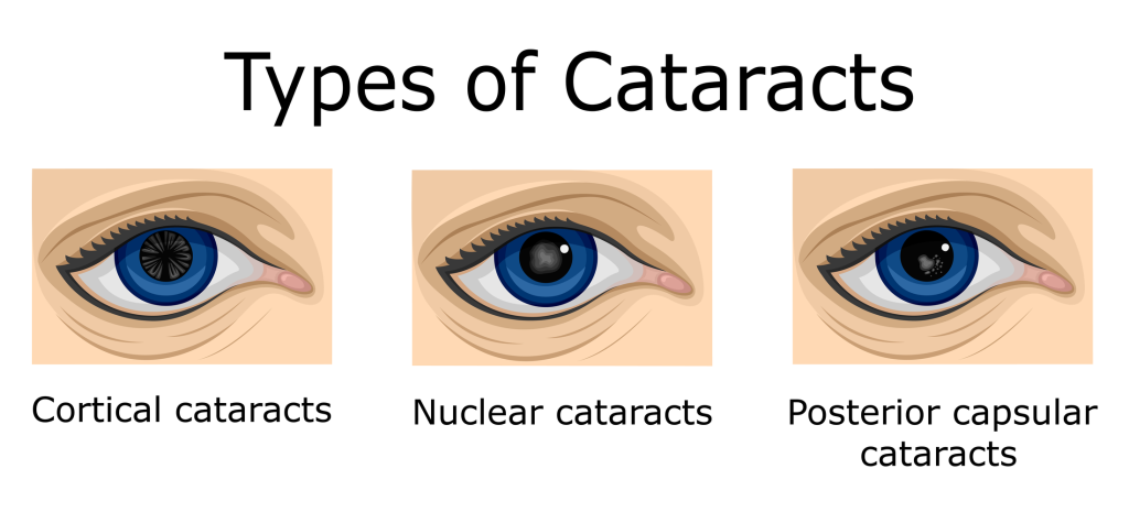 types of cataract