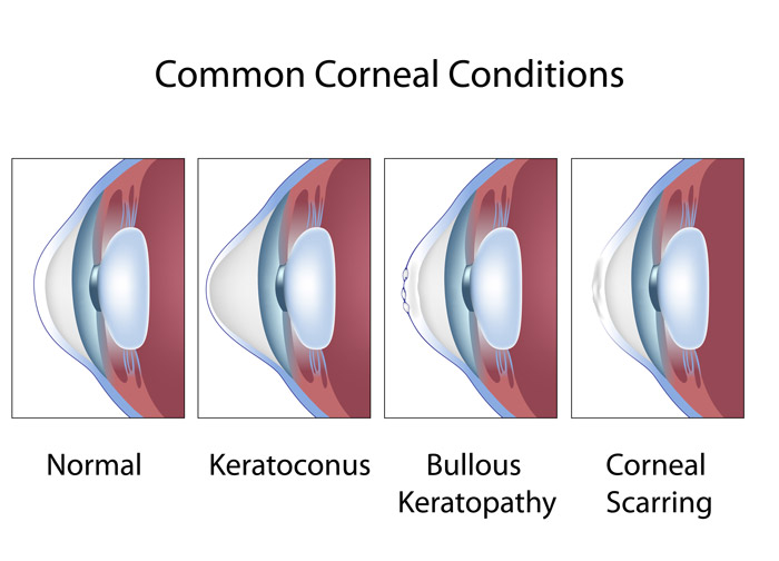 Causes and Conditions of cornea