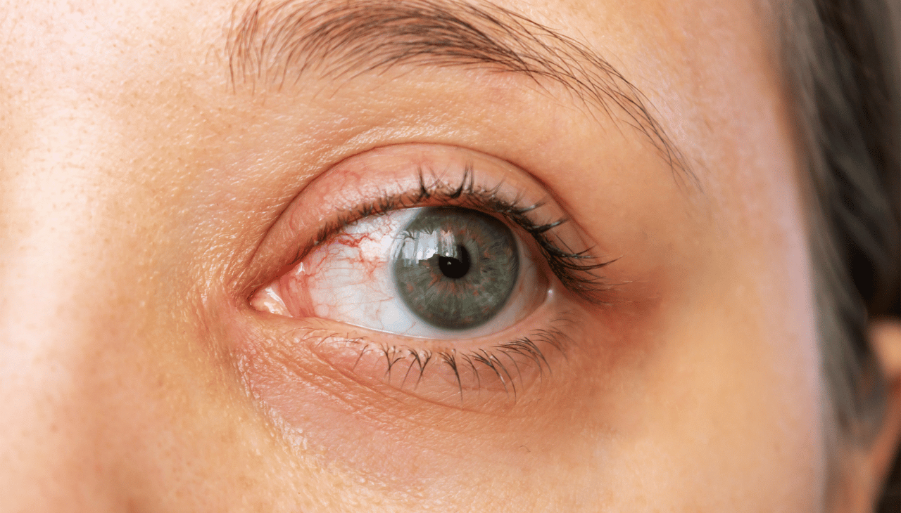 understandibg dry eye syndome with laxmi eye Hospital