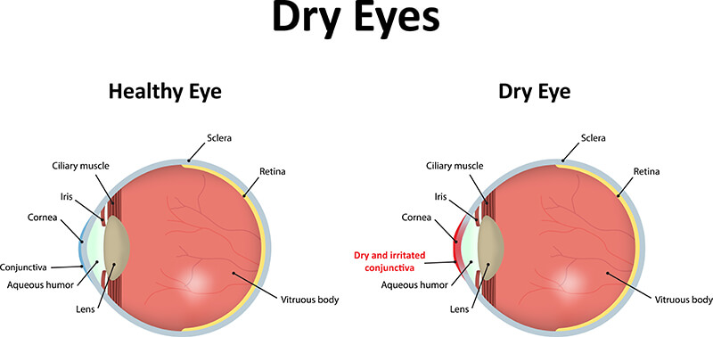 what is dry eye syndrome