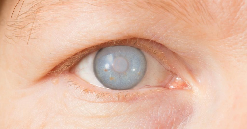cataract