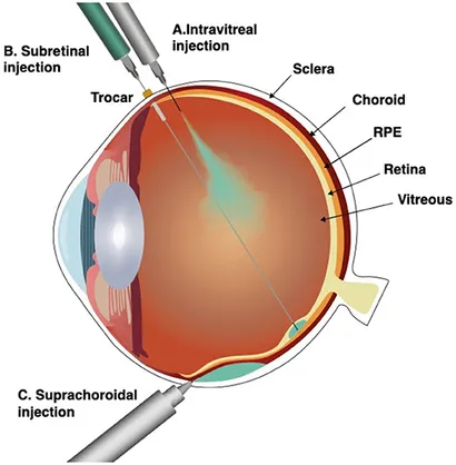 Procedure & Recovery of Intravitreal Gene Therapy