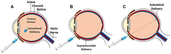 What is Intravitreal Gene Therapy?