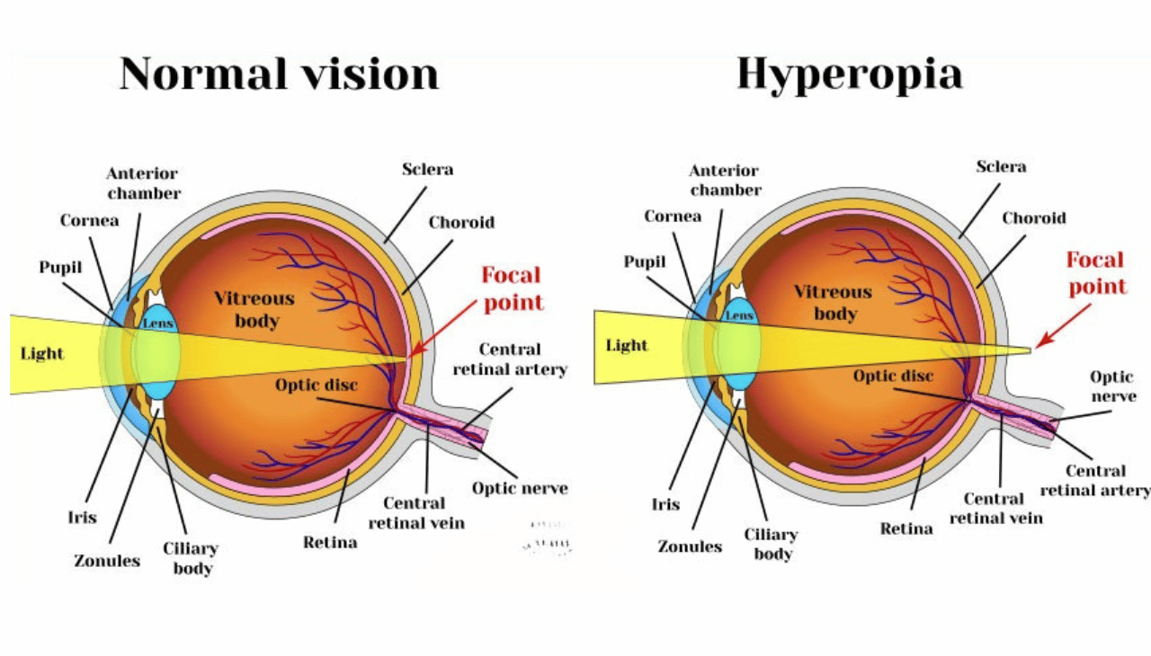 Hypermetropia