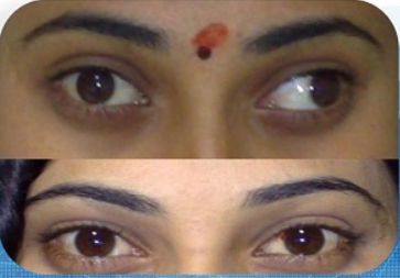 Precautions to Follow After Squint Surgery