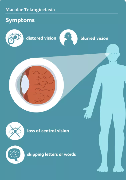 symptoms of Macular Telangiectasia