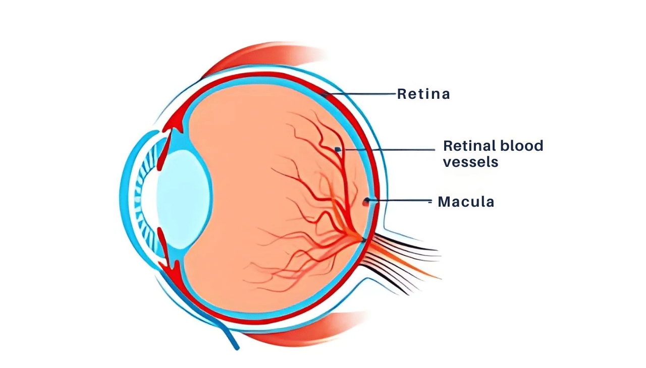 Understanding Macular Telangiectasia