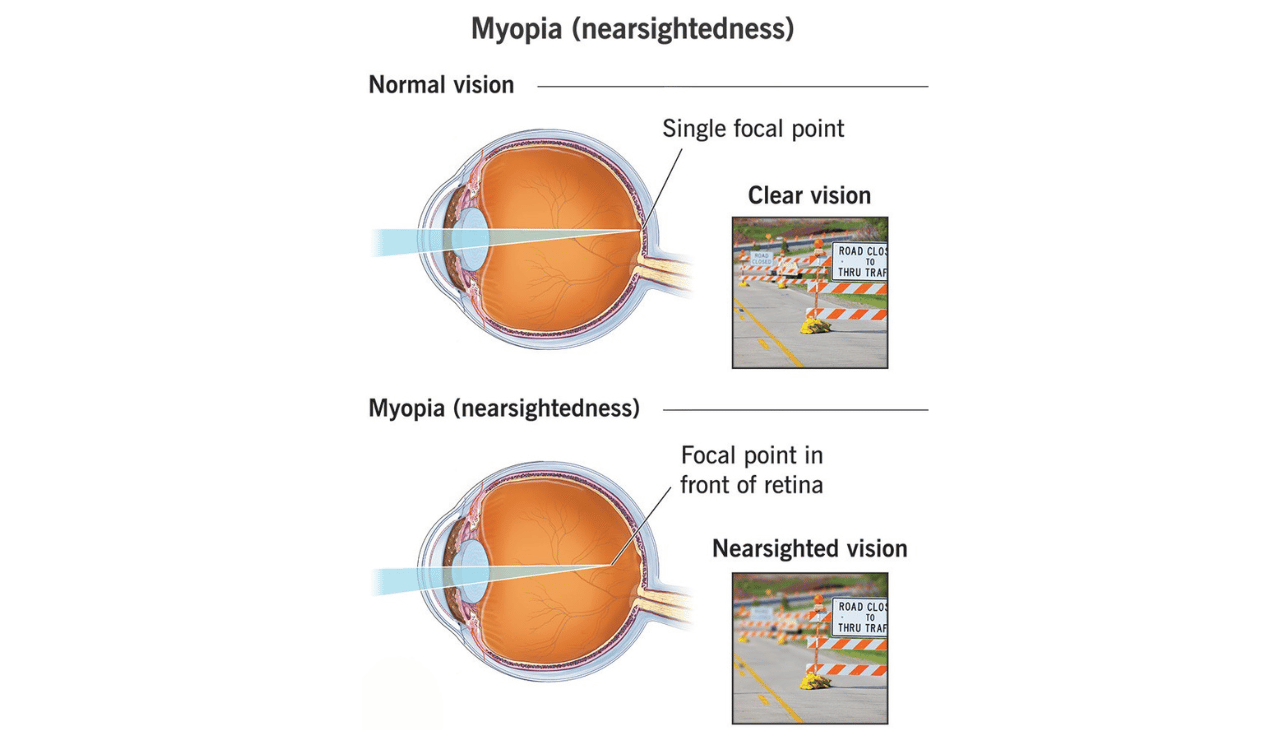 Myopia and AI in Eye Care