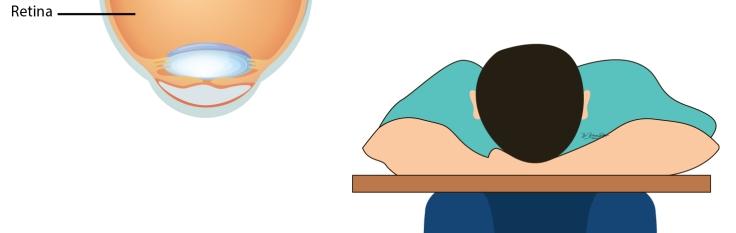 Head Positioning After Retina Surgery