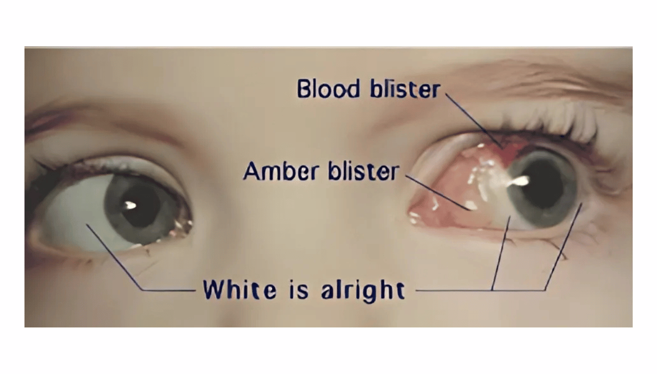 Squint Surgery