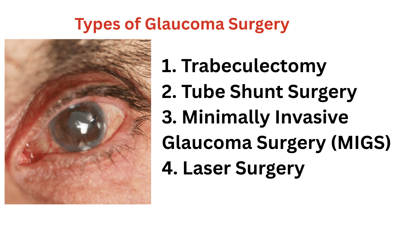 Types of Glaucoma Surgery