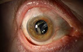 Pseudoexfoliation Syndrome