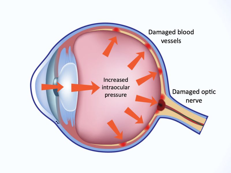 What Is Intraocular Pressure (IOP)?