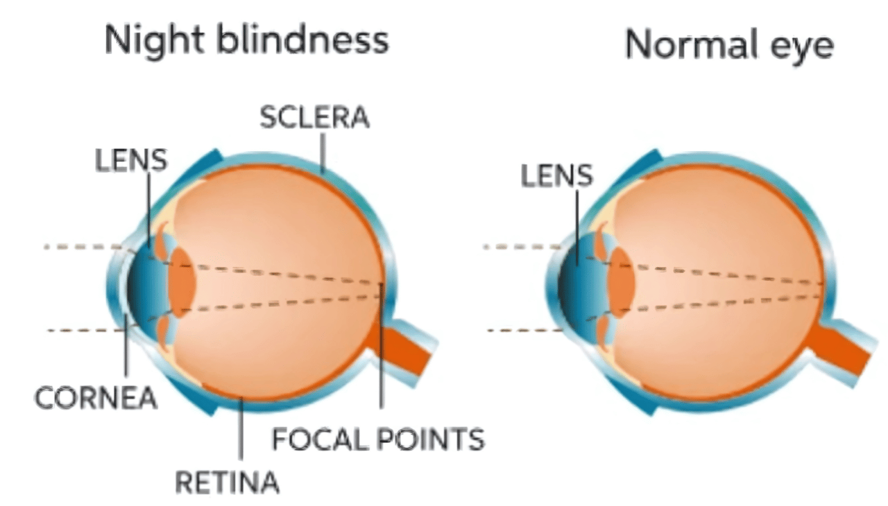 Causes and Symptoms of Night Blindness