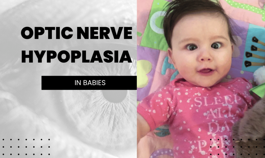 What is Optic Nerve Hypoplasia (ONH) in Babies ?