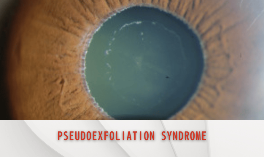 Glaucoma Risk Rises with Pseudoexfoliation Syndrome