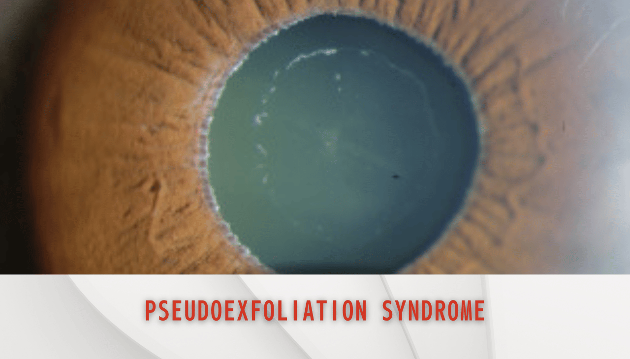 Glaucoma Risk Rises with Pseudoexfoliation Syndrome