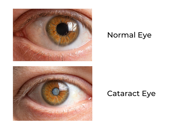 What Is a Cataract?