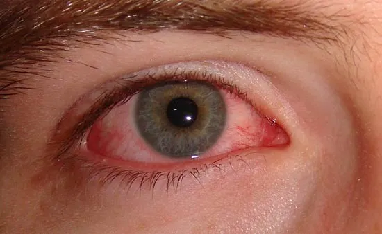 Understanding Vernal conjunctivitis risk with Laxmi Eye Hospital