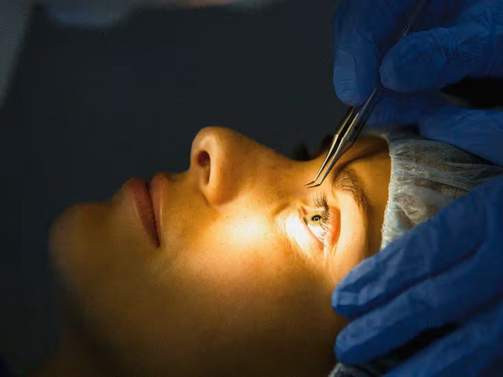 LASIK Eye Surgery During Monsoon
