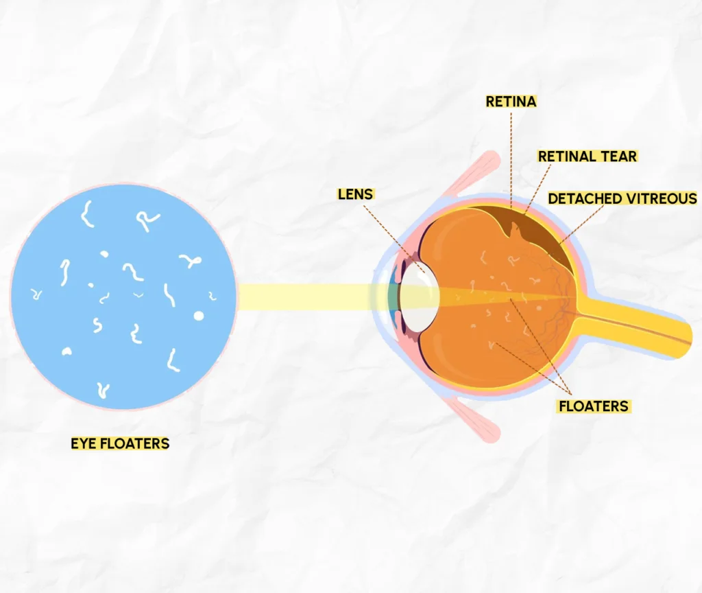 Learn about Post-Cataract Wavy Lines