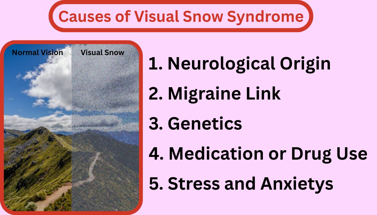 Causes of Visual Snow Syndrome