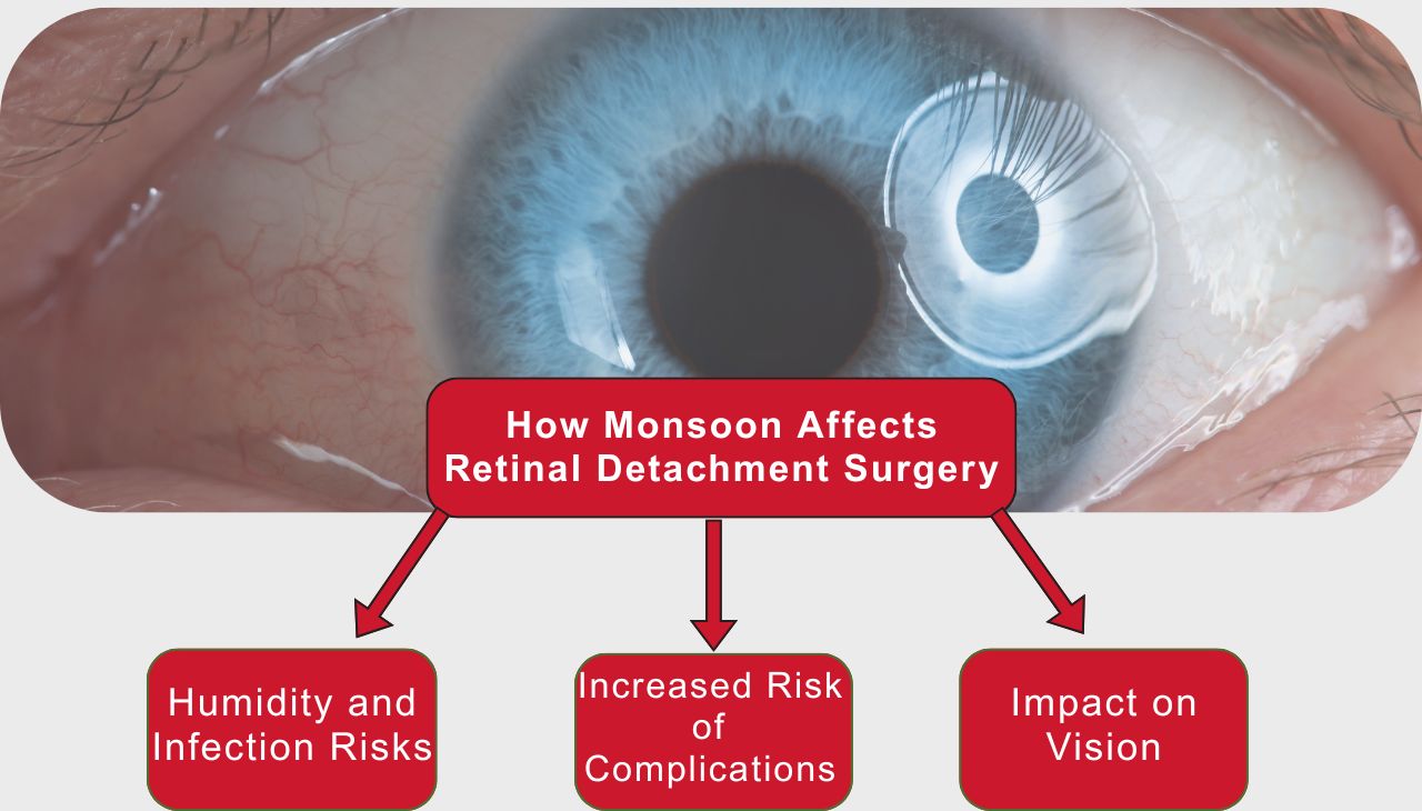 How Monsoon Affects Retinal Detachment Surgery