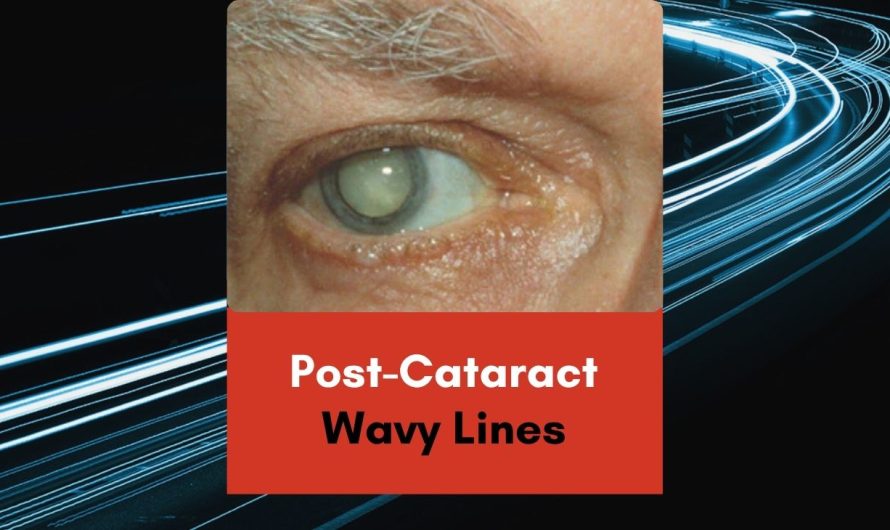 Post-Cataract Wavy Lines: Normal or Concerning?