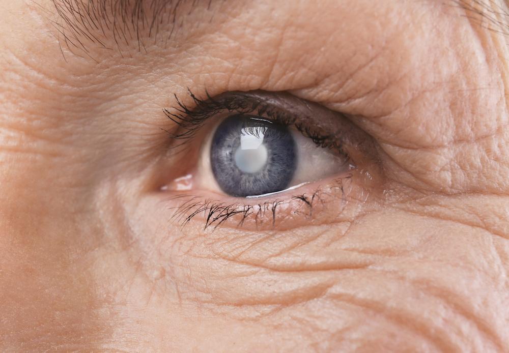 Post-Cataract Wavy Lines