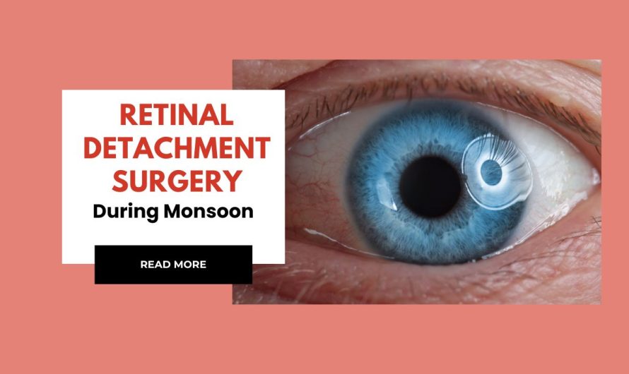 Retinal Detachment Surgery During Monsoon: What You Can Expect
