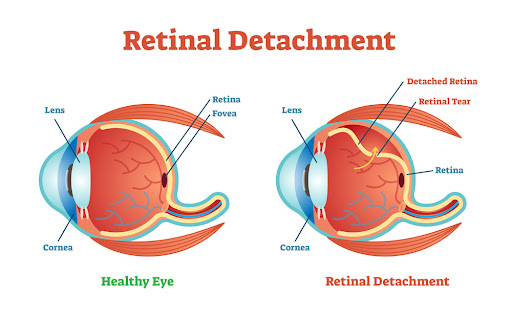 What is Retinal Detachment?