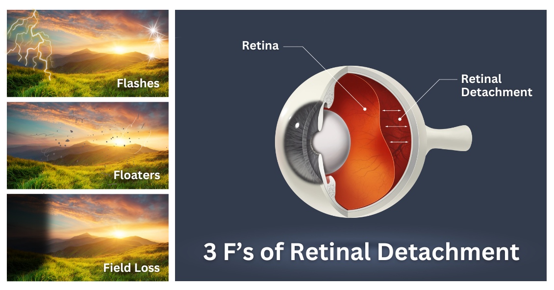 What You Can Expect from Retinal Detachment Surgery