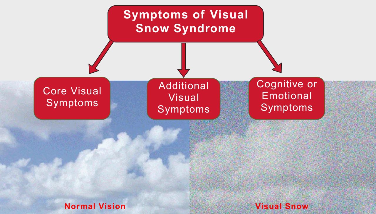 Symptoms of Visual Snow Syndrome