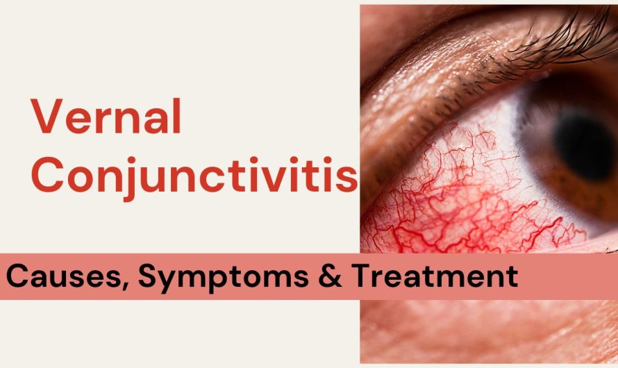 Understanding Vernal Conjunctivitis: Causes, Symptoms & Treatment