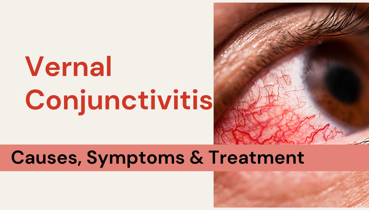 Understanding Vernal Conjunctivitis: Causes, Symptoms & Treatment