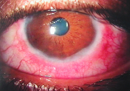 What Is Vernal Conjunctivitis?