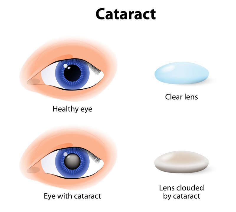 Cataracts