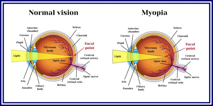 Myopia