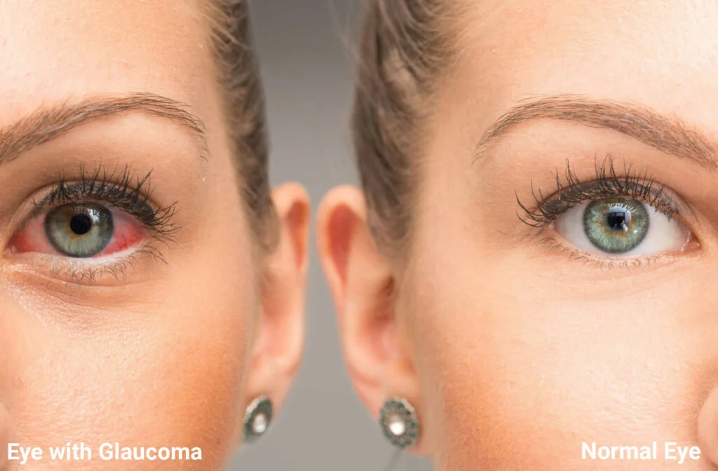 Glaucoma eye and normal eye