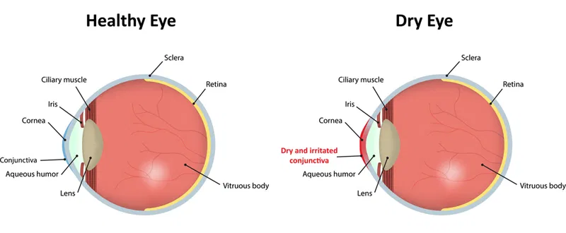 dry eye and normal eye