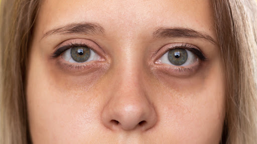 How Sleep Affects Your Eyes