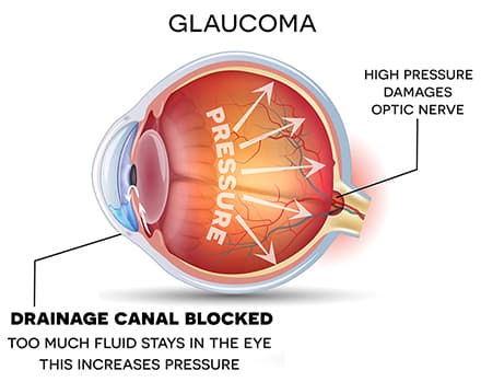 How Glaucoma Surgery Protects Your Vision