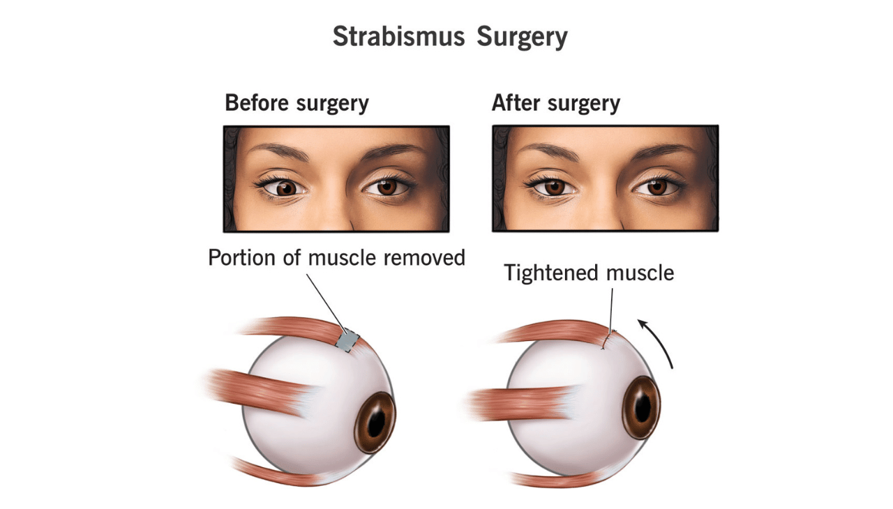 Understanding Squint Eye Surgery