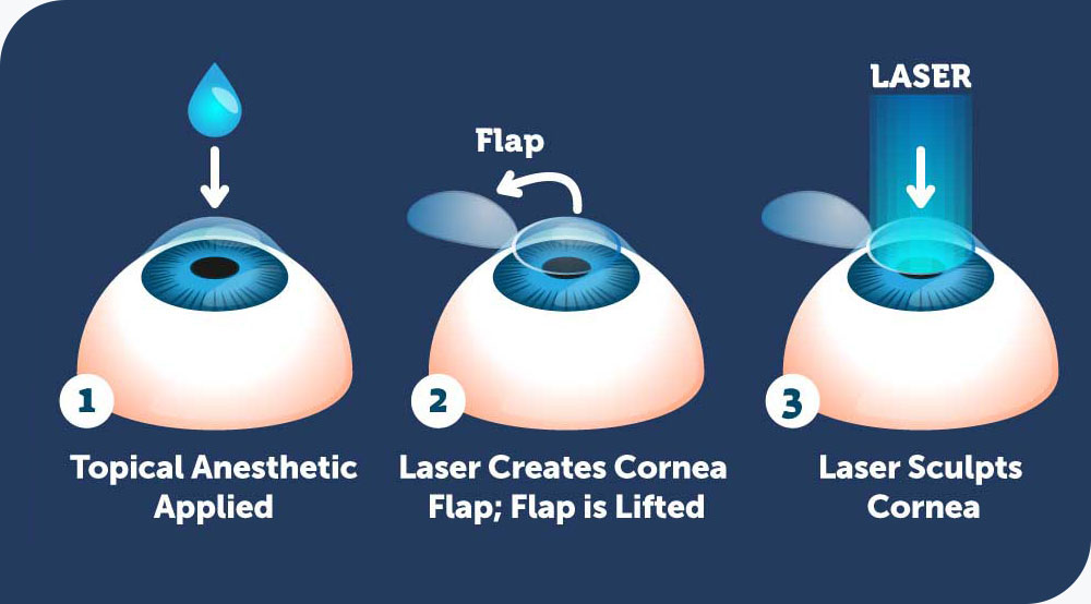 Treatment Options: How Laser Vision Correction Works