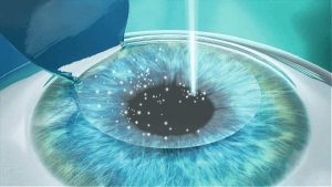 Laser Vision Correction